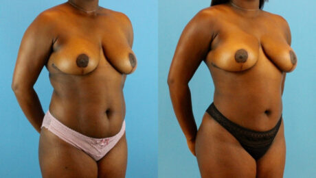 Brazilian Butt Lift case #4904