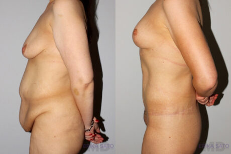 Post Bariatric Surgery (Massive Weight Loss) case #6771