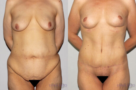Post Bariatric Surgery (Massive Weight Loss) case #6771