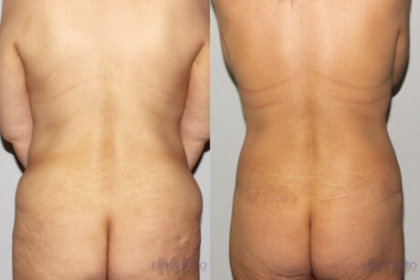 Post Bariatric Surgery (Massive Weight Loss) case #6771