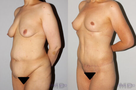 Post Bariatric Surgery (Massive Weight Loss) case #6771
