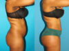 Brazilian Butt Lift case #4906 slider thumbnail
