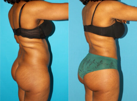 Brazilian Butt Lift case #4906