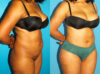 Brazilian Butt Lift case #4906 slider thumbnail