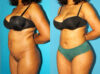 Brazilian Butt Lift case #4906 slider thumbnail