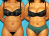 Brazilian Butt Lift case #4906 slider thumbnail