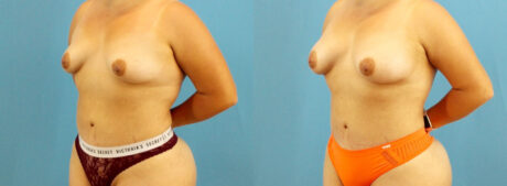 Fat Grafting to the Breast case #256201