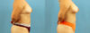 Fat Grafting to the Breast case #256201 slider thumbnail