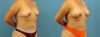 Fat Grafting to the Breast case #256201 slider thumbnail