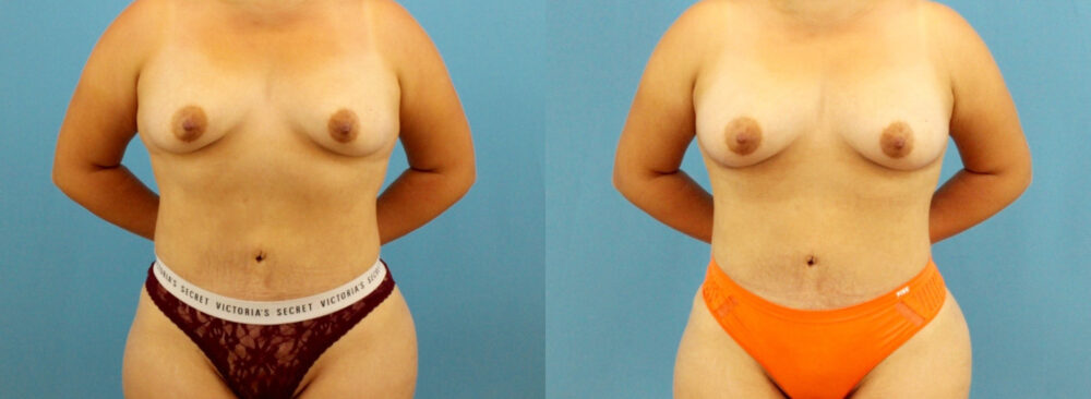 Fat Grafting to the Breast case #256201