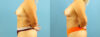 Fat Grafting to the Breast case #256201 slider thumbnail