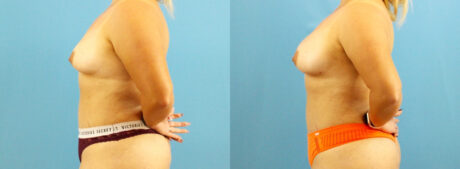Fat Grafting to the Breast case #256201