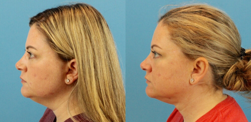 Submental Liposuction case #6944