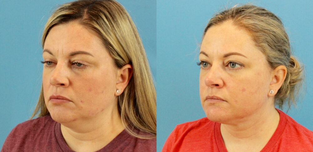 Submental Liposuction case #6944