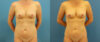 Fat Grafting to the Breast case #256188 slider thumbnail