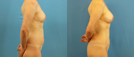 Fat Grafting to the Breast case #256188