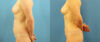 Fat Grafting to the Breast case #256188 slider thumbnail