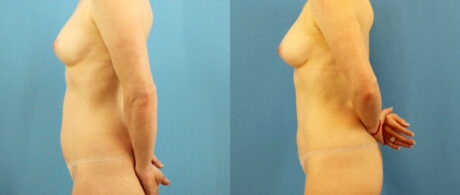 Fat Grafting to the Breast case #256188