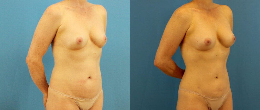 Fat Grafting to the Breast case #256188