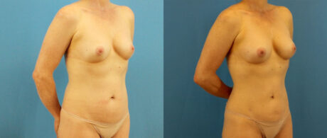 Fat Grafting to the Breast case #256188