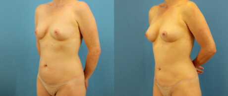 Fat Grafting to the Breast case #256188