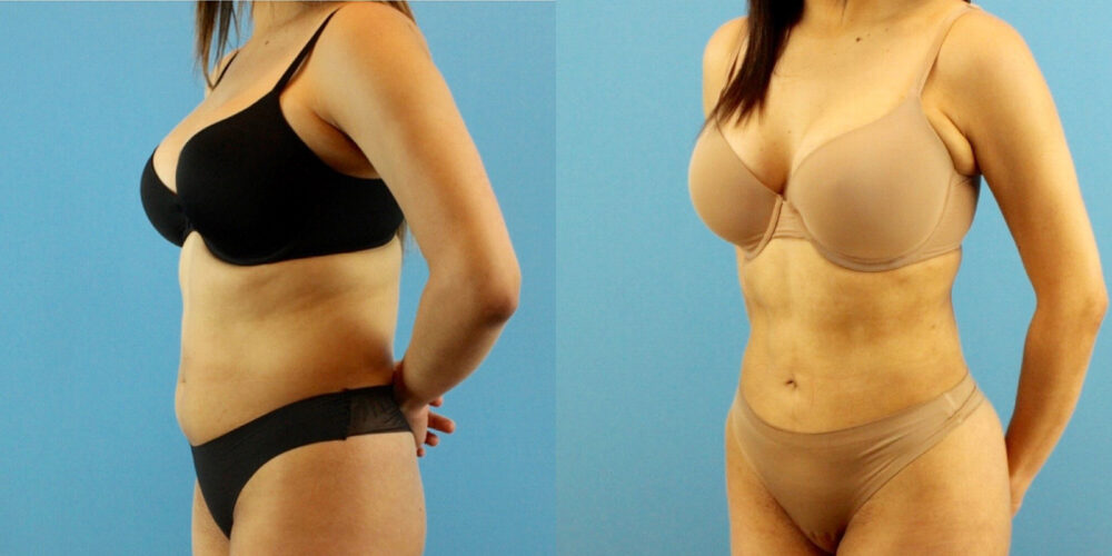 Liposuction case #6008