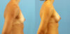 Breast Augmentation case #6315 slider thumbnail