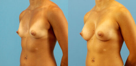 Breast Augmentation case #6315
