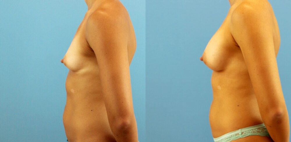 Breast Augmentation case #6315
