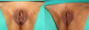 Labiaplasty case #5756 slider thumbnail