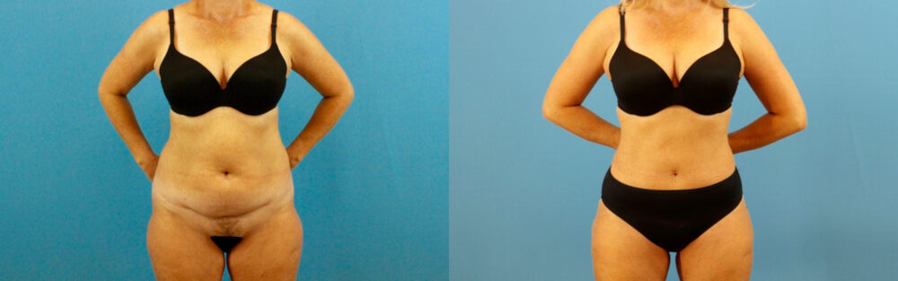 Tummy Tuck case #7345