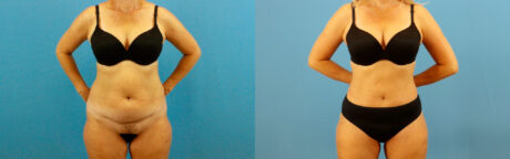 Tummy Tuck case #7345