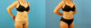 Tummy Tuck case #7345 slider thumbnail