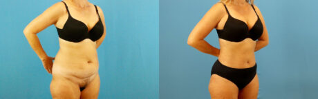 Tummy Tuck case #7345