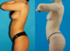 Brazilian Butt Lift case #4907 slider thumbnail