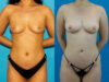 Brazilian Butt Lift case #4907 slider thumbnail