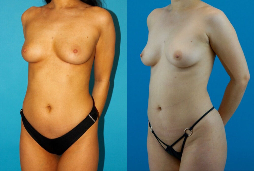 Brazilian Butt Lift case #4907