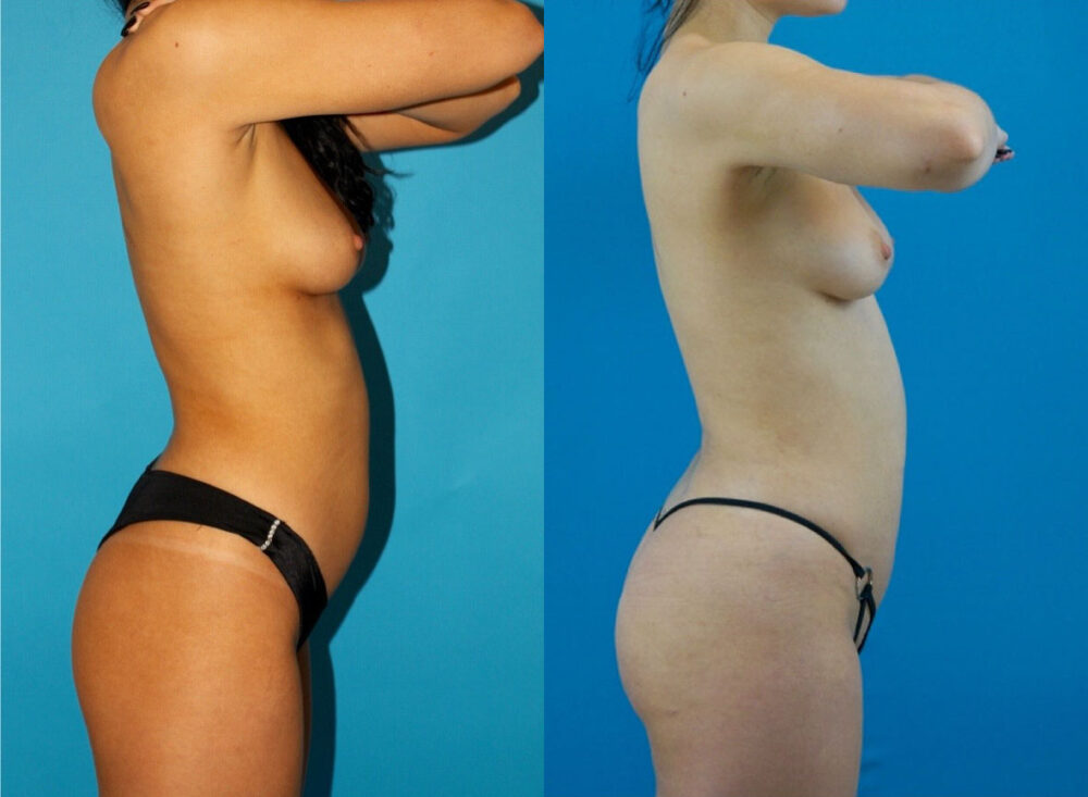 Brazilian Butt Lift case #4907