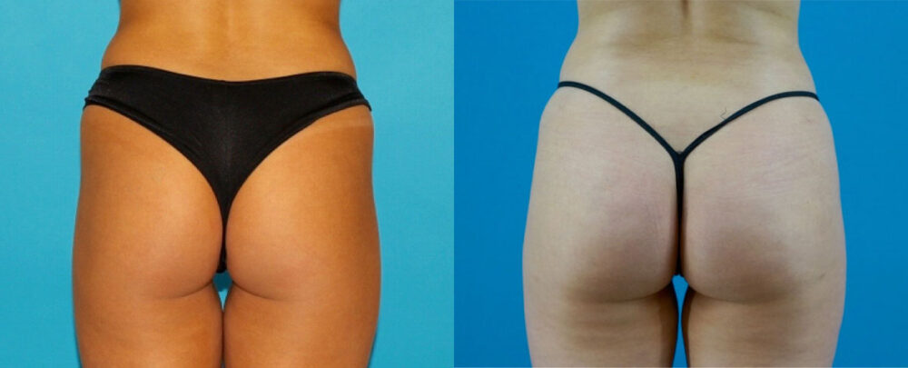 Brazilian Butt Lift case #4907