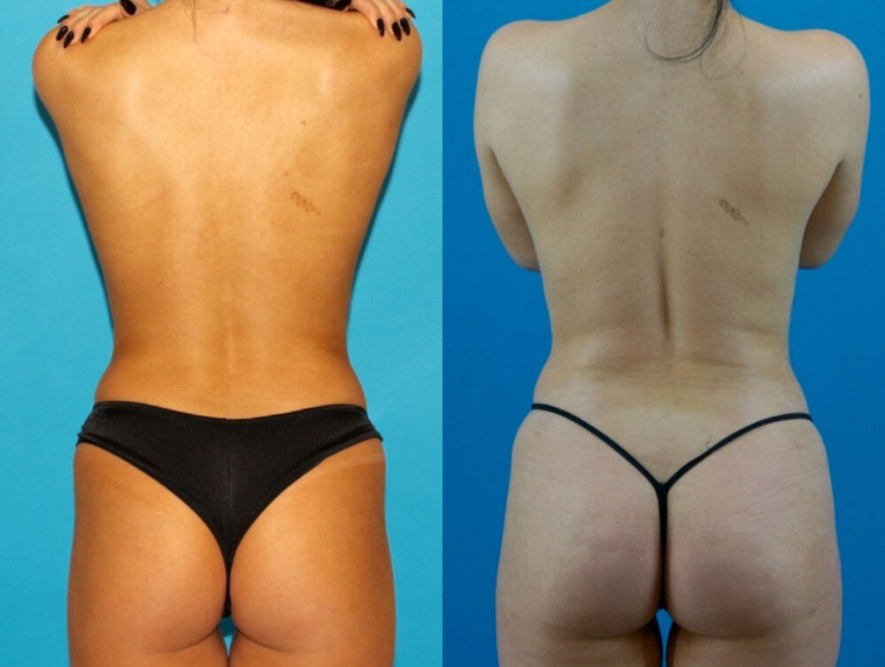 Brazilian Butt Lift case #4907