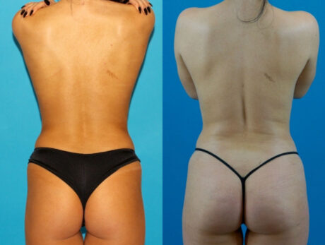 Brazilian Butt Lift case #4907