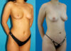 Brazilian Butt Lift case #4907 slider thumbnail