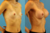 Breast Augmentation case #6321 slider thumbnail