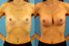 Breast Augmentation case #6321 slider thumbnail
