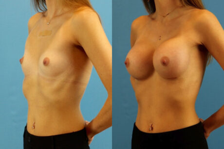 Breast Augmentation case #6321
