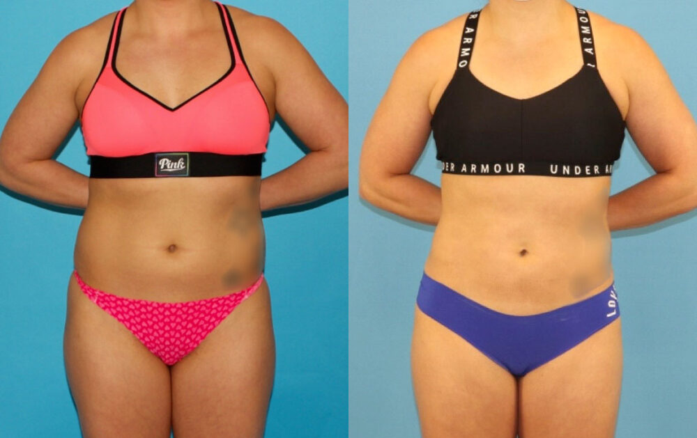 Liposuction case #6009