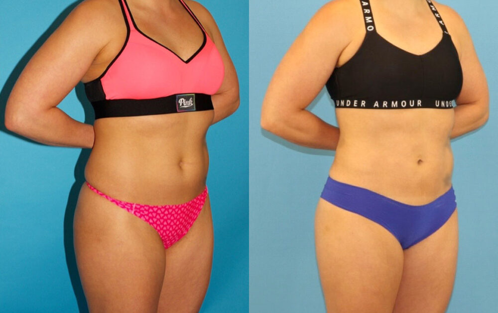 Liposuction case #6009