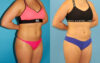 Liposuction case #6009 slider thumbnail