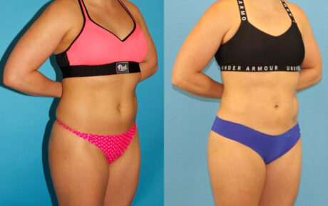 Liposuction case #6009