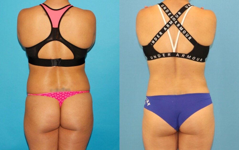 Liposuction case #6009